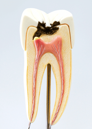 Model of a tooth with deep decay, which may require direct pulp capping